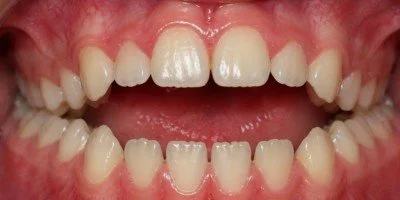 Severe anterior open bite