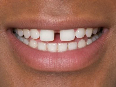 close up of teeth showing gaps.