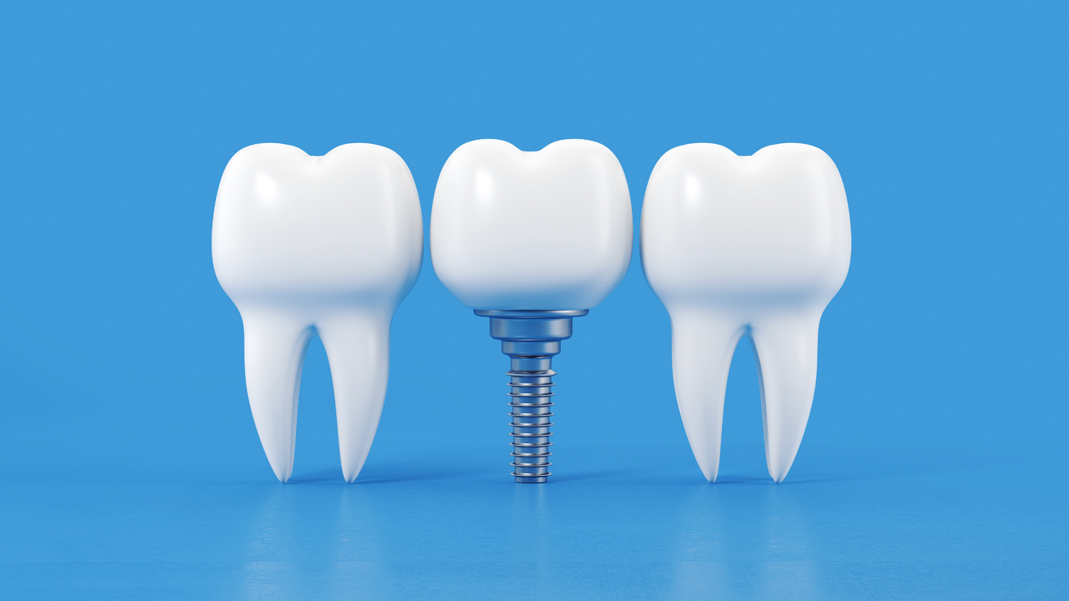 Dental Implant surgery, a Patient-Friendly Guide by iDental