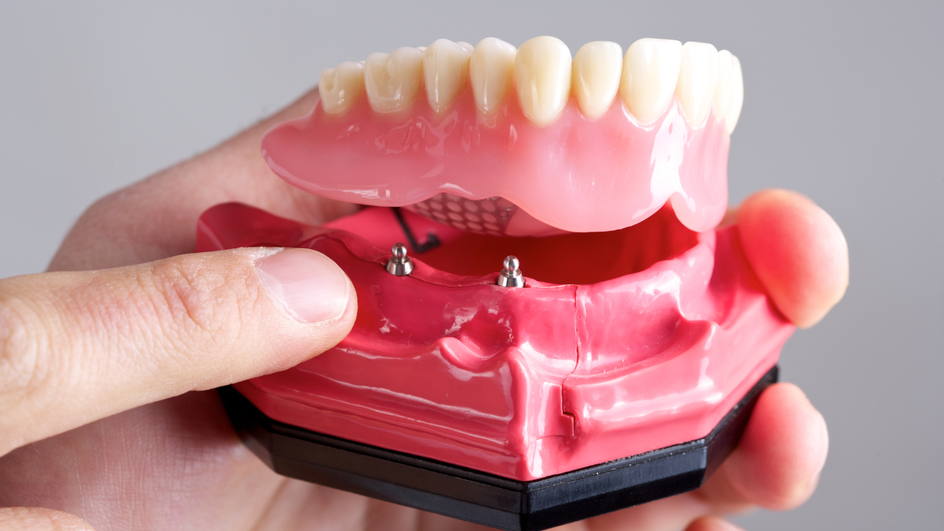 Exploring Your Options: Traditional Dentures vs. Implant Dentures