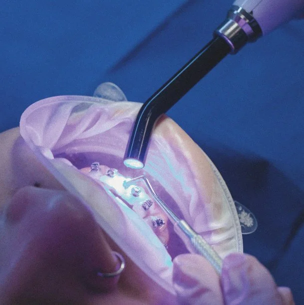 Close-up of a dental procedure with a dental handpiece and a curing light over a person's mouth, which is kept open by a rubber dam. The person has multiple braces on their teeth.