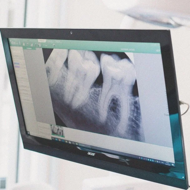 Close-up of a computer monitor displaying a dental X-ray image of teeth.