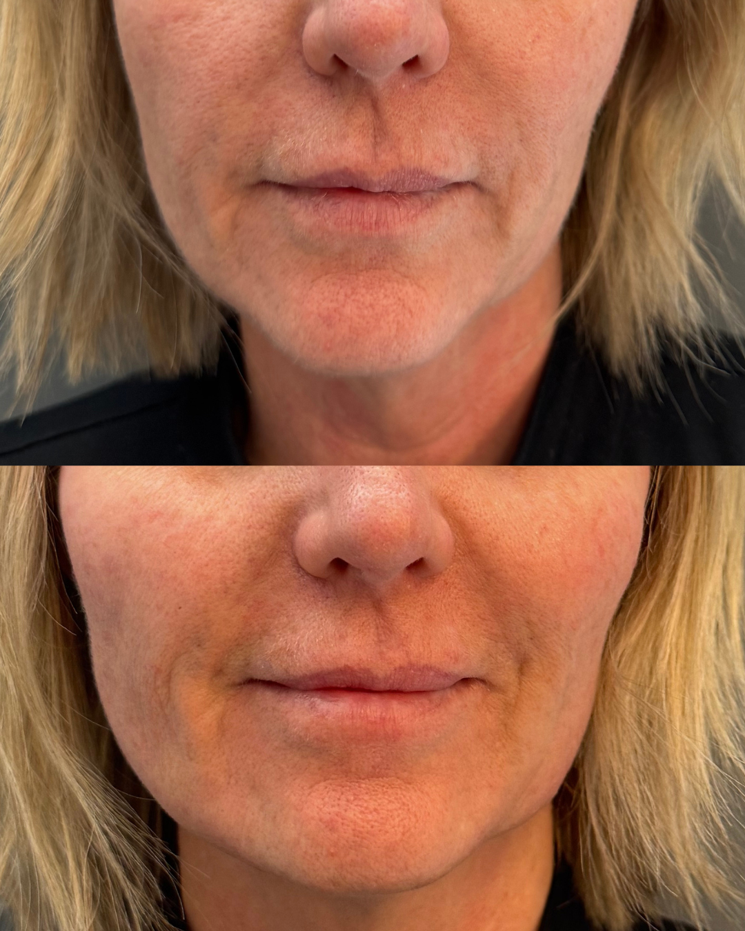 Palms_before_after_client5_lips.png