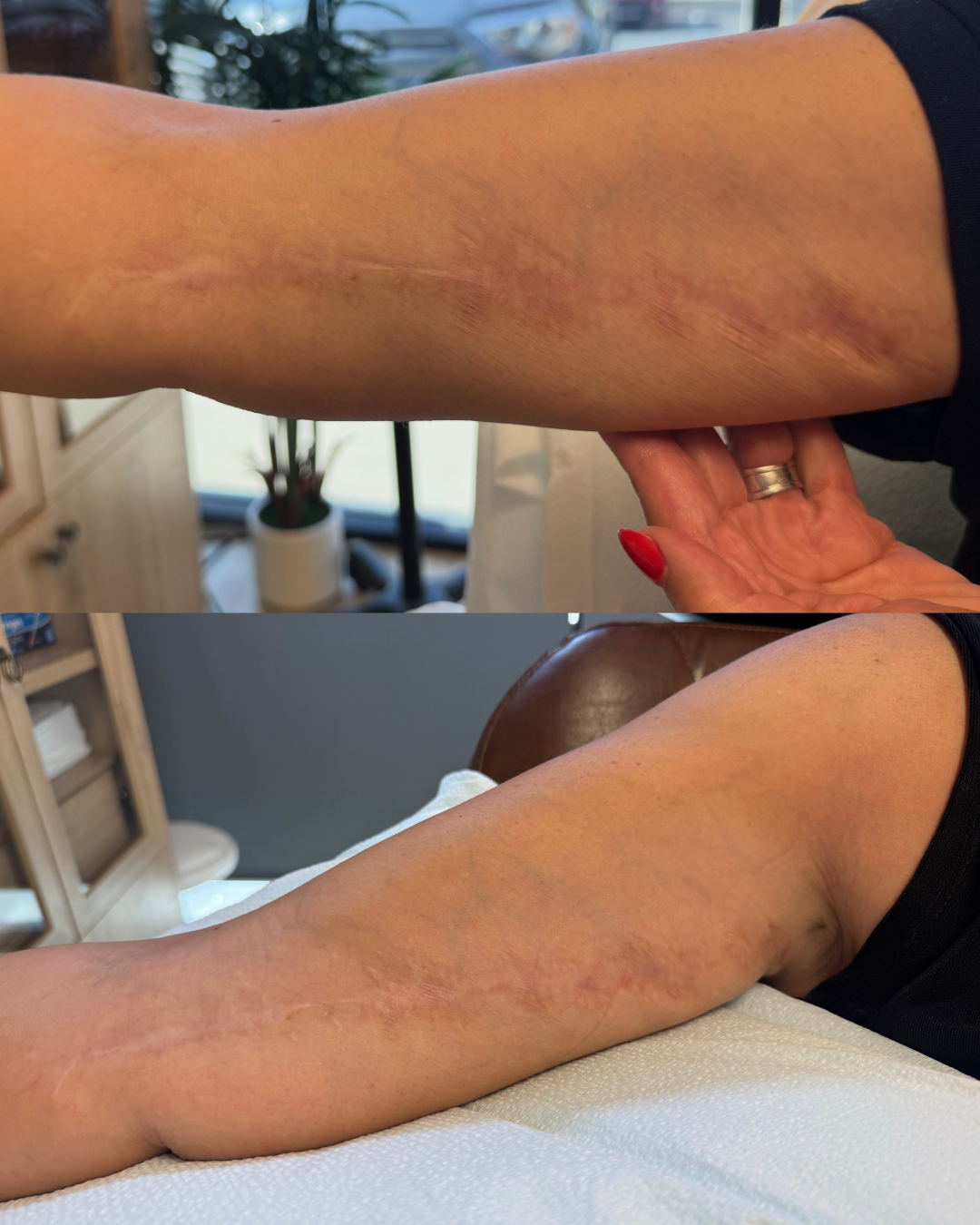 Palms_before_after_client3_arms.png