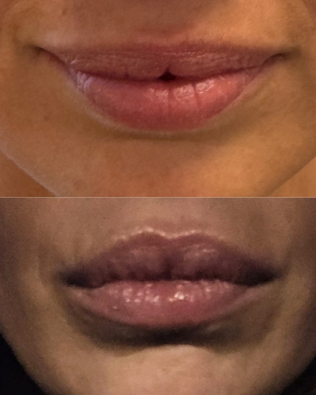 Palms_before_after_client4_lips.png