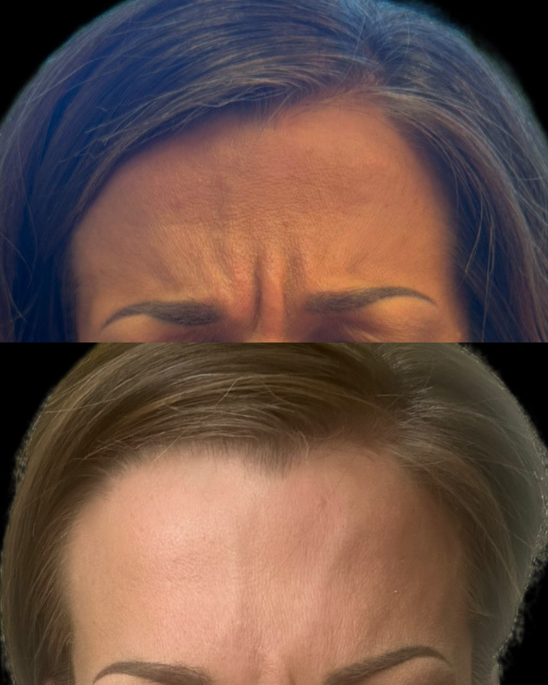 Palms_before_after_client2_forehead2.png