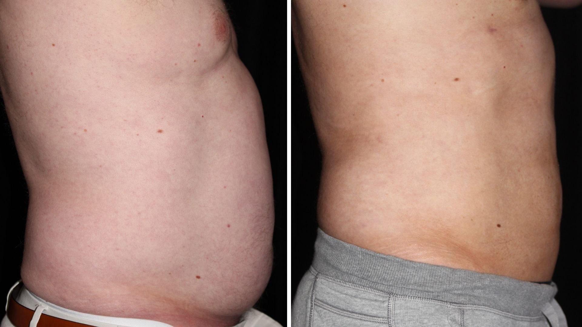 male liposuction 360 side view