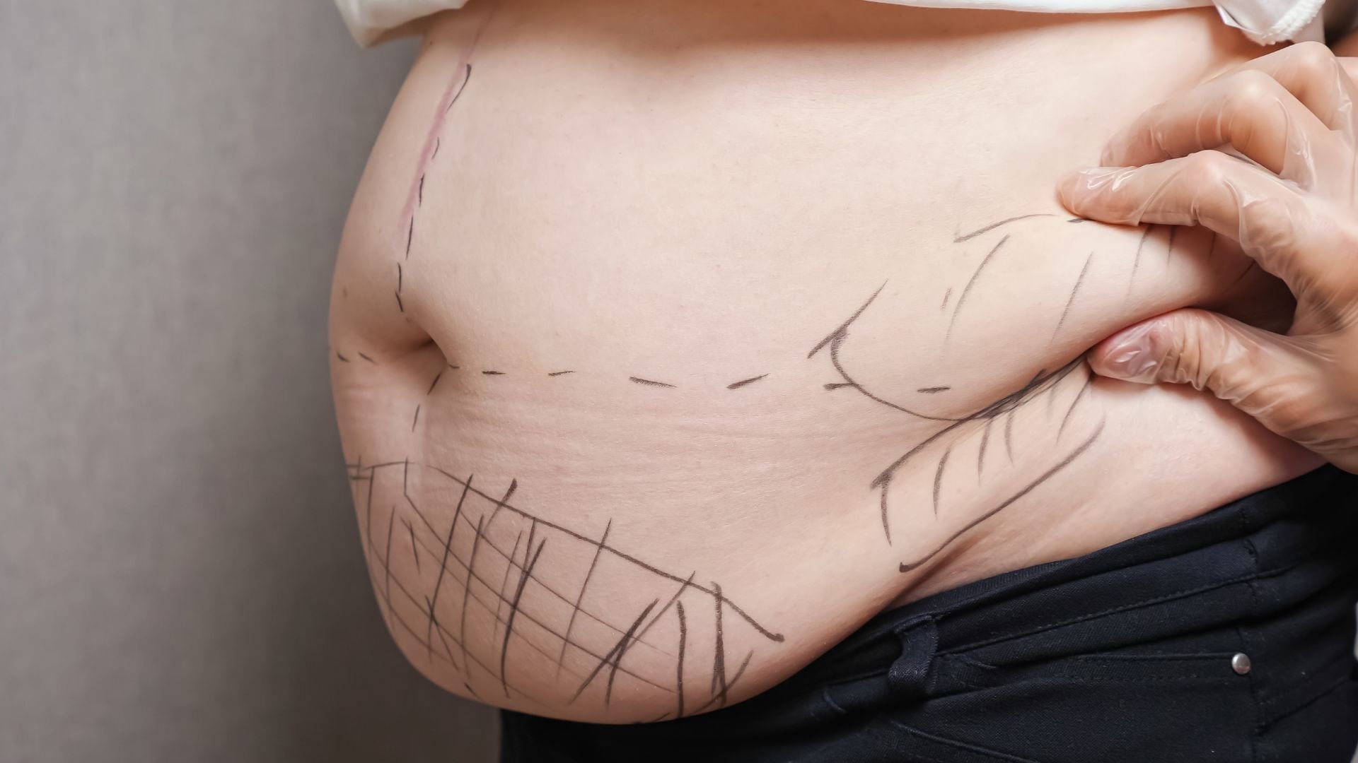 Male stomach with surgical lines for tummy tuck surgery.