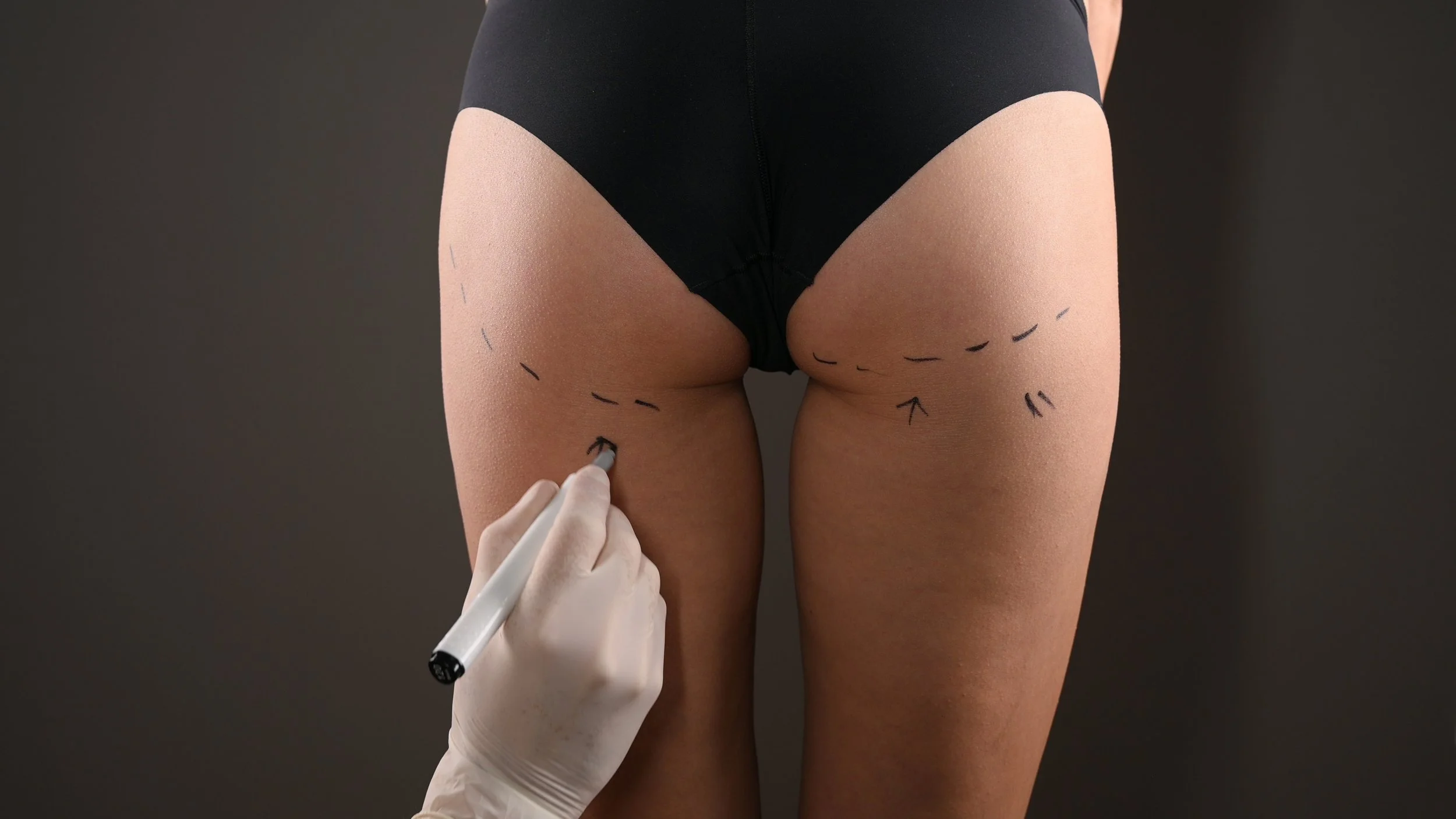 A person in black underwear is standing with their back to the camera. The person's thighs and buttocks are marked with black surgical markings, and a hand wearing a latex glove is drawing an arrow on the right thigh with a marker.