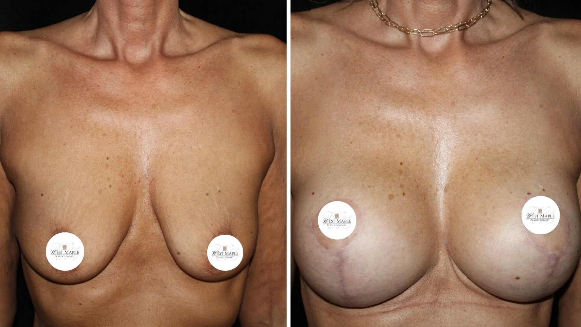 breast surgery mastopexy before and after