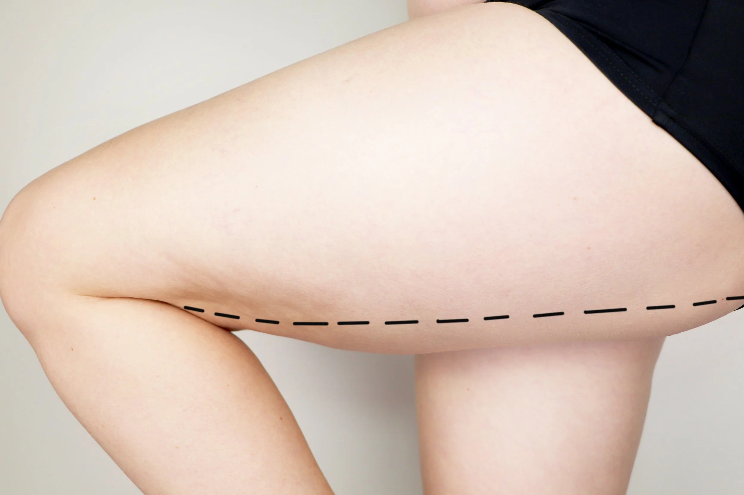 A close-up of a person's upper thigh and hip with a dashed line drawn along the side of the thigh.