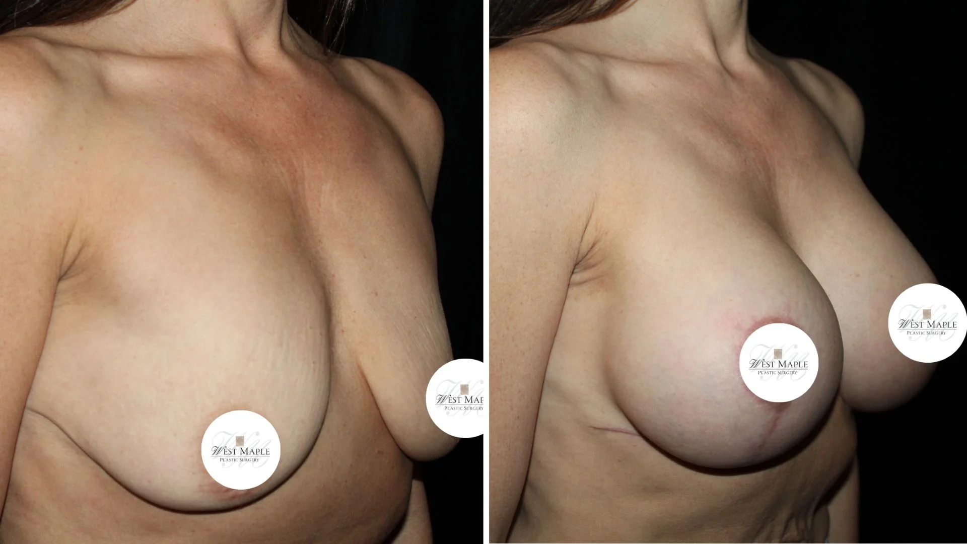 breast surgery mastopexy before and after