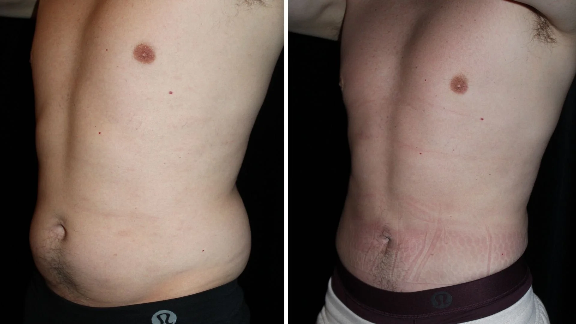 male liposuction 360 quarter side view