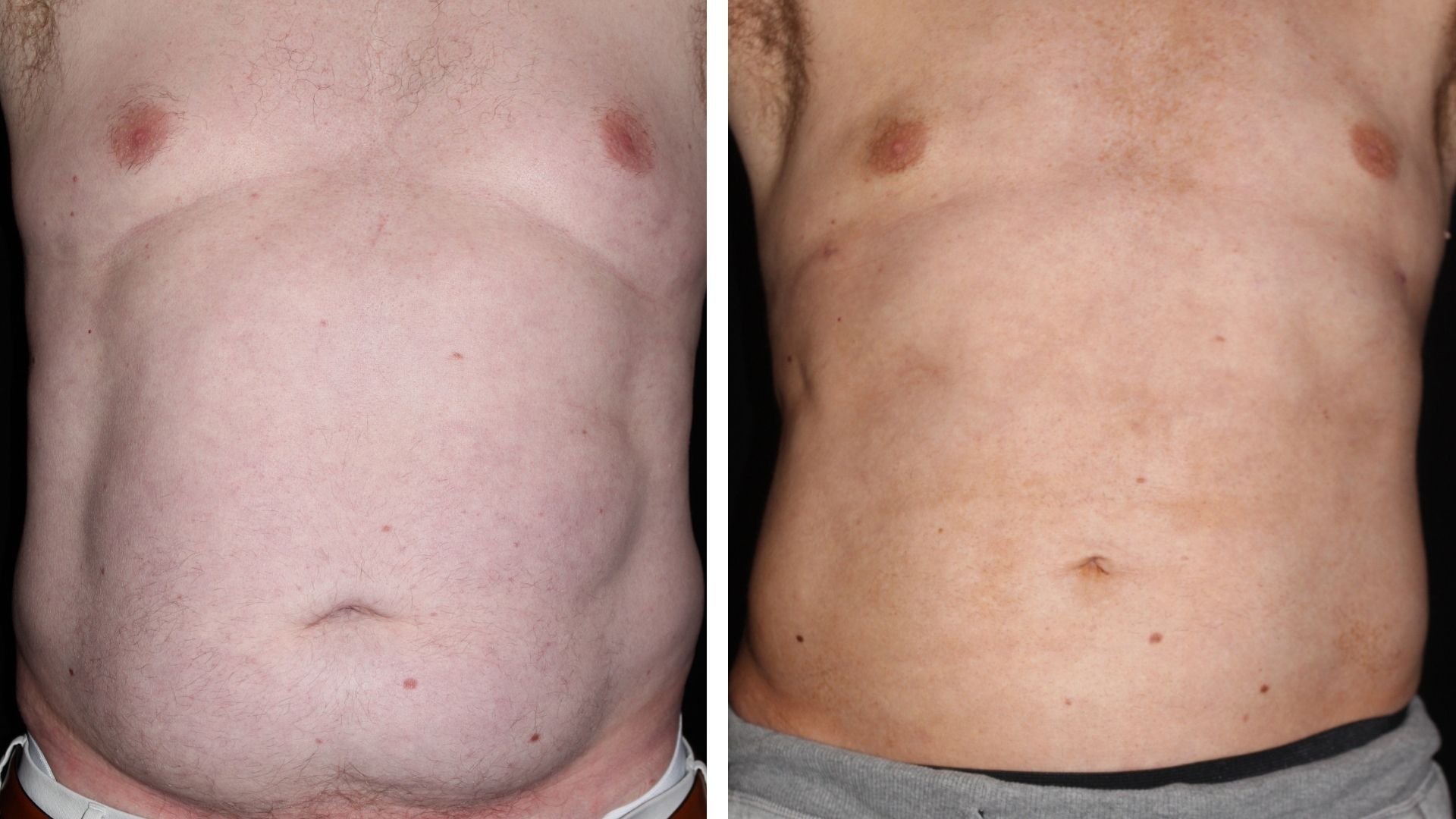 male liposuction 360 front view