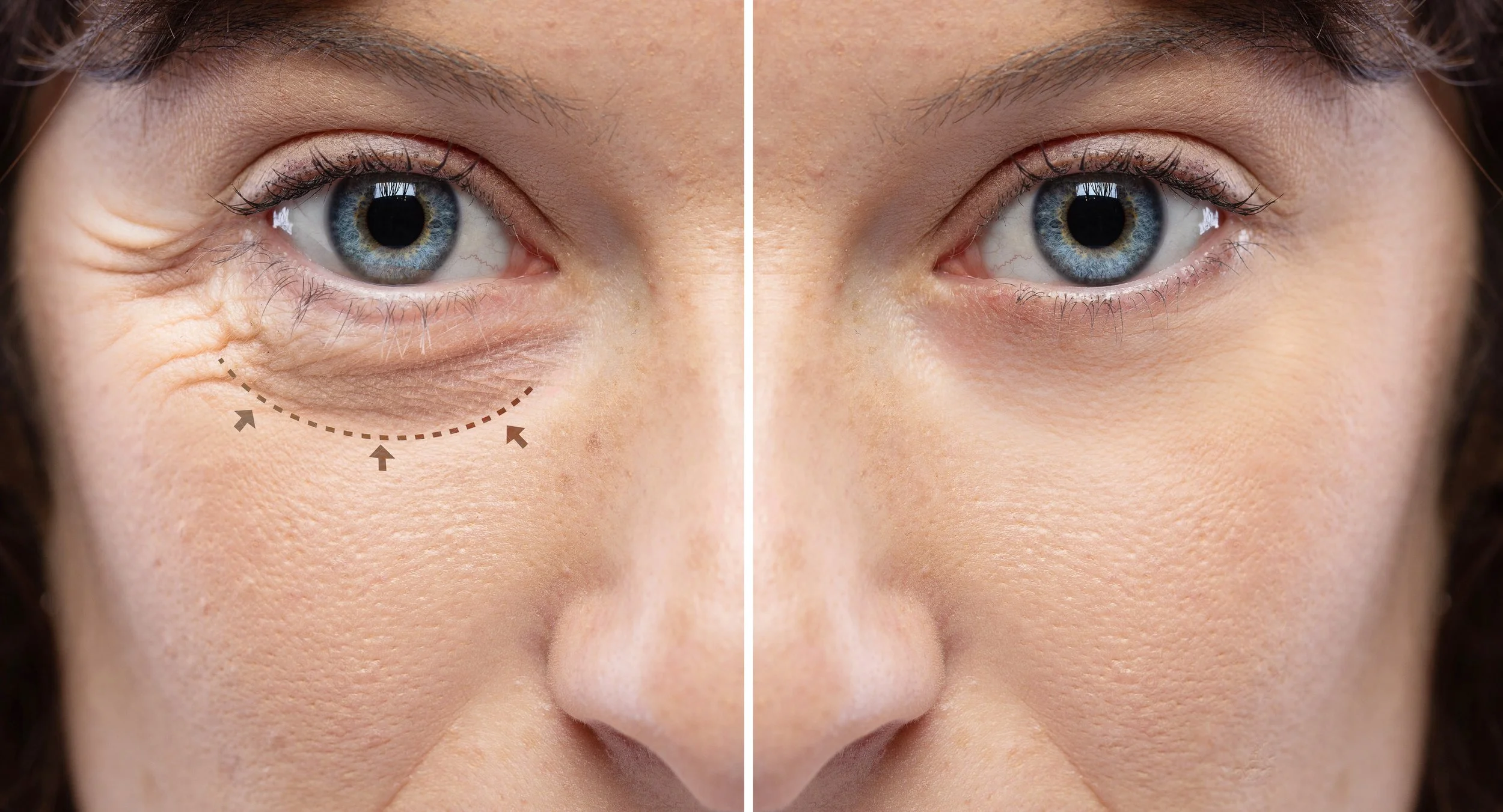 Close-up of a person's face, showing the left eye with under-eye wrinkles and skin concerns, and the right eye with smoother skin, illustrating before and after skincare treatment.