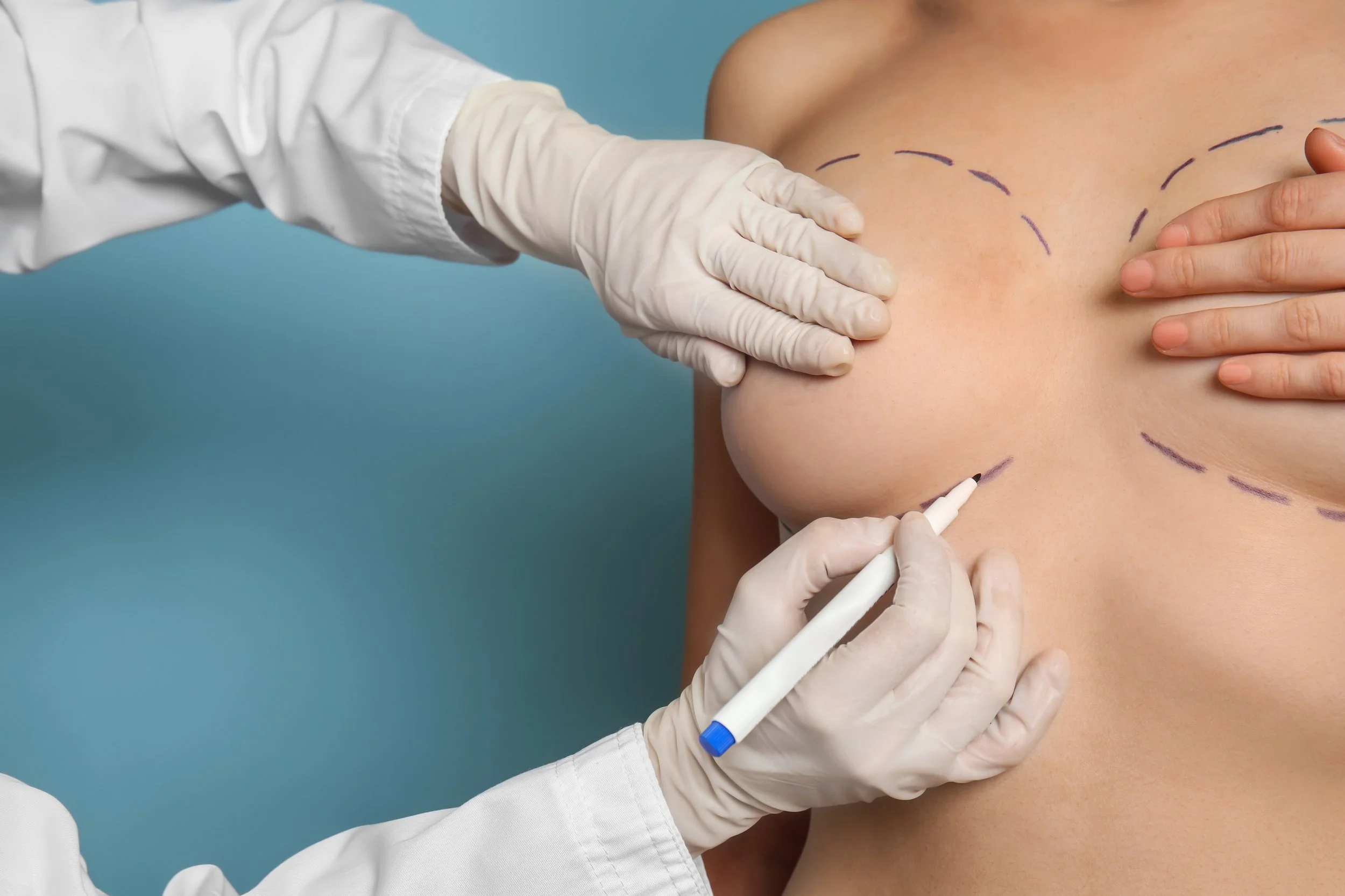 A medical professional with gloved hands drawing surgical markings on a woman's chest, likely for breast augmentation or reconstruction surgery.
