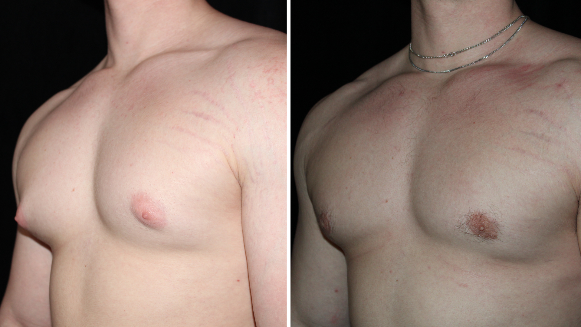 Side-by-side close-up photos of a man's chest showing before and after from gynecomastia surgery.