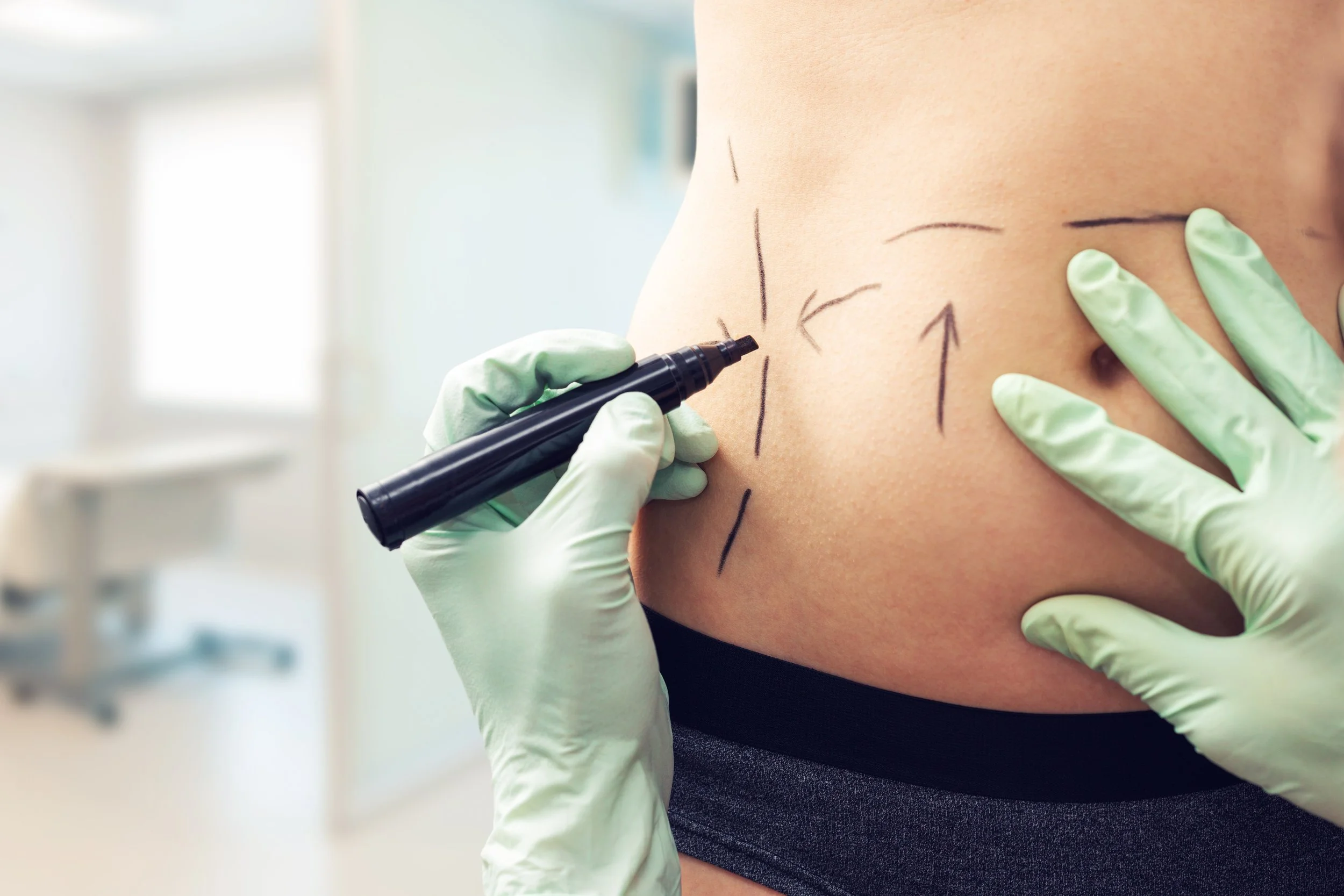A person with markings on their abdomen for a cosmetic procedure, with a medical professional wearing gloves drawing on the skin with a marker.