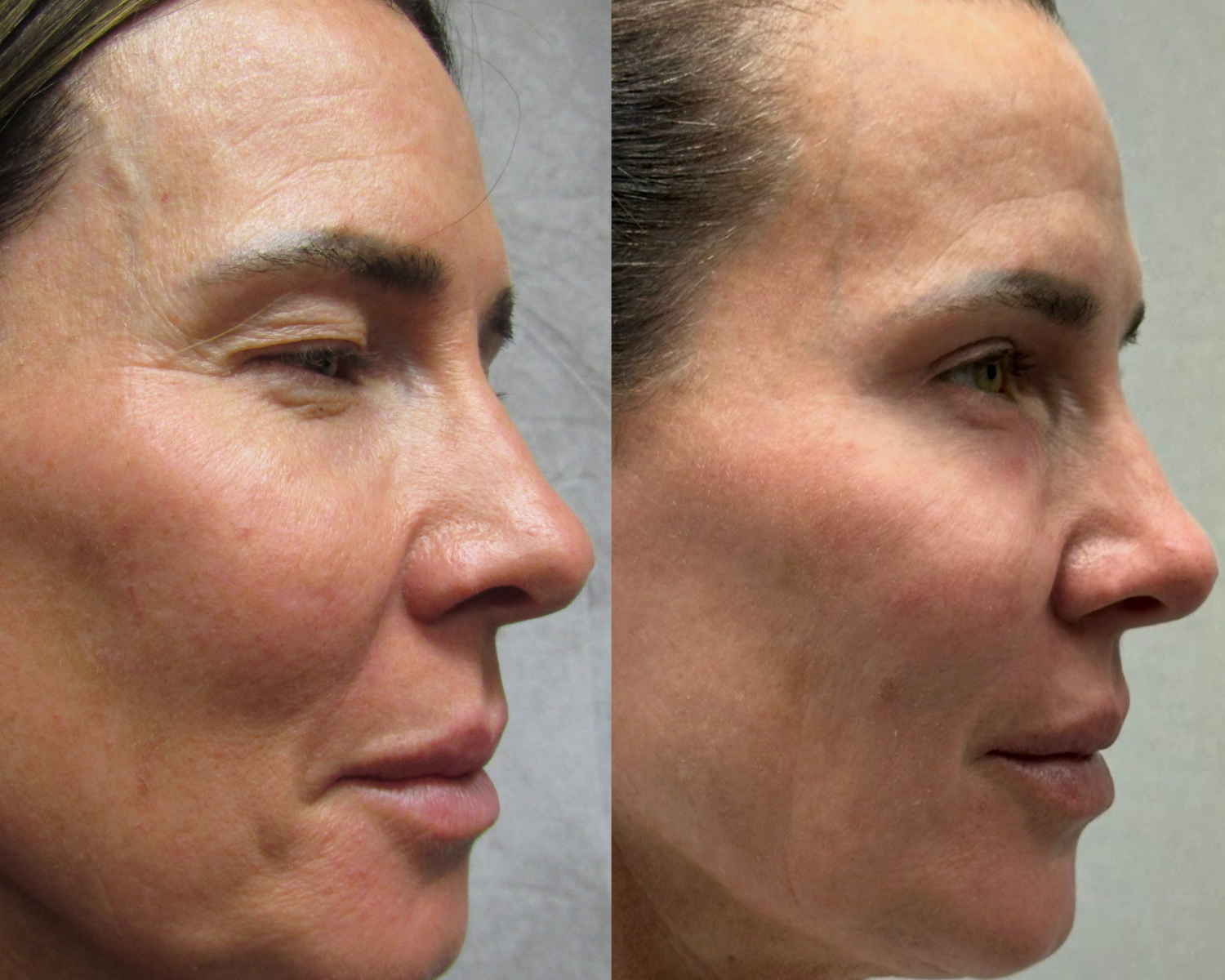 eye upper and lower blepharoplasty on woman
