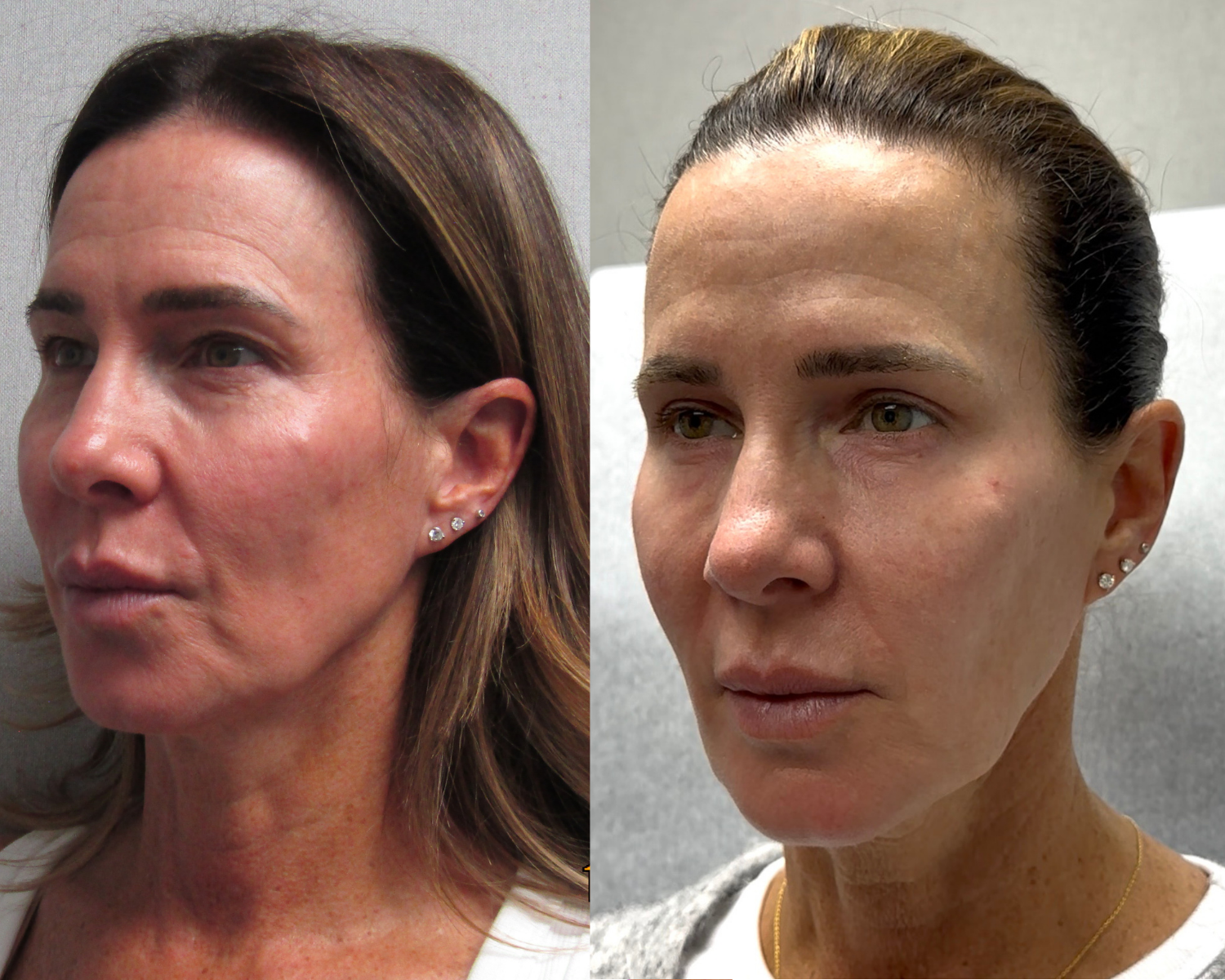 eye upper and lower blepharoplasty on woman - side