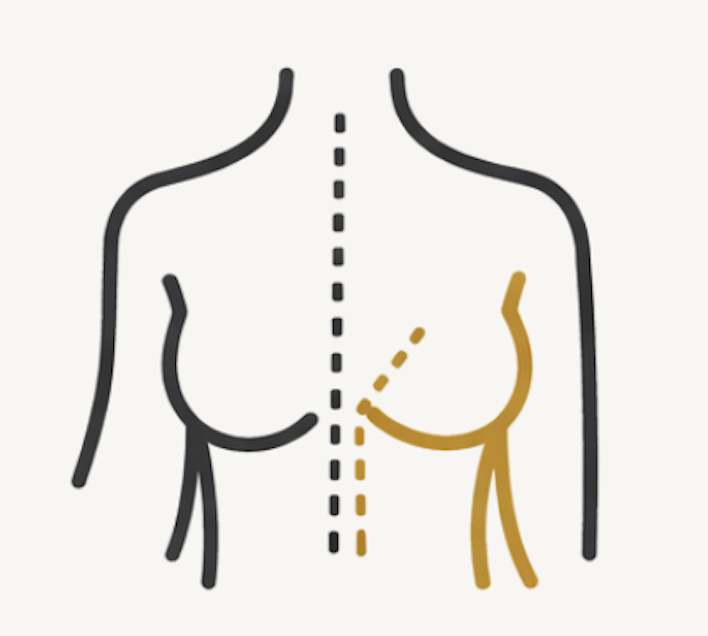 Diagram showing breast cancer surgery options, with a dotted line dividing the breast and removal of part of the breast.
