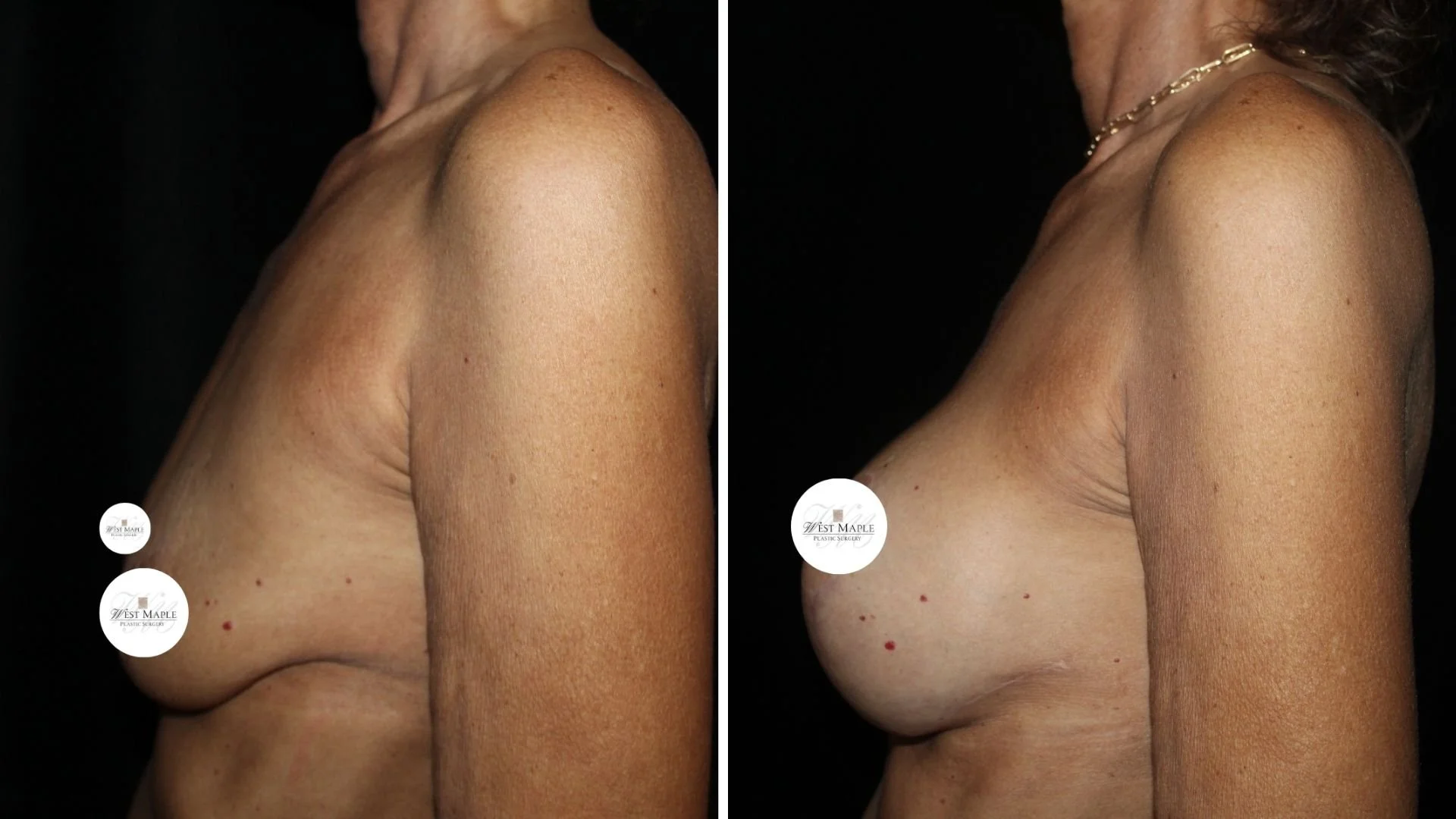 breast surgery mastopexy before and after