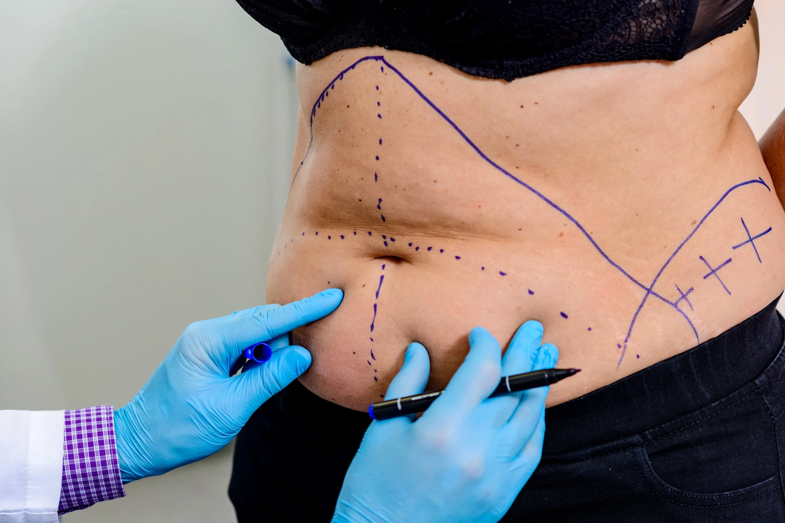 Doctor or surgeon marks preoperative lines on a patient's abdomen with a blue marker in preparation for surgery.
