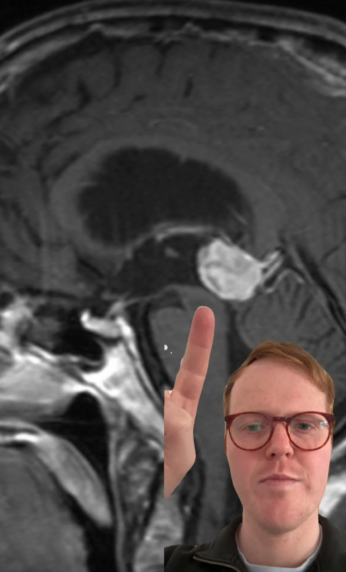 Why Brainstem Lesions Are Not as Complex as You Were Taught 
