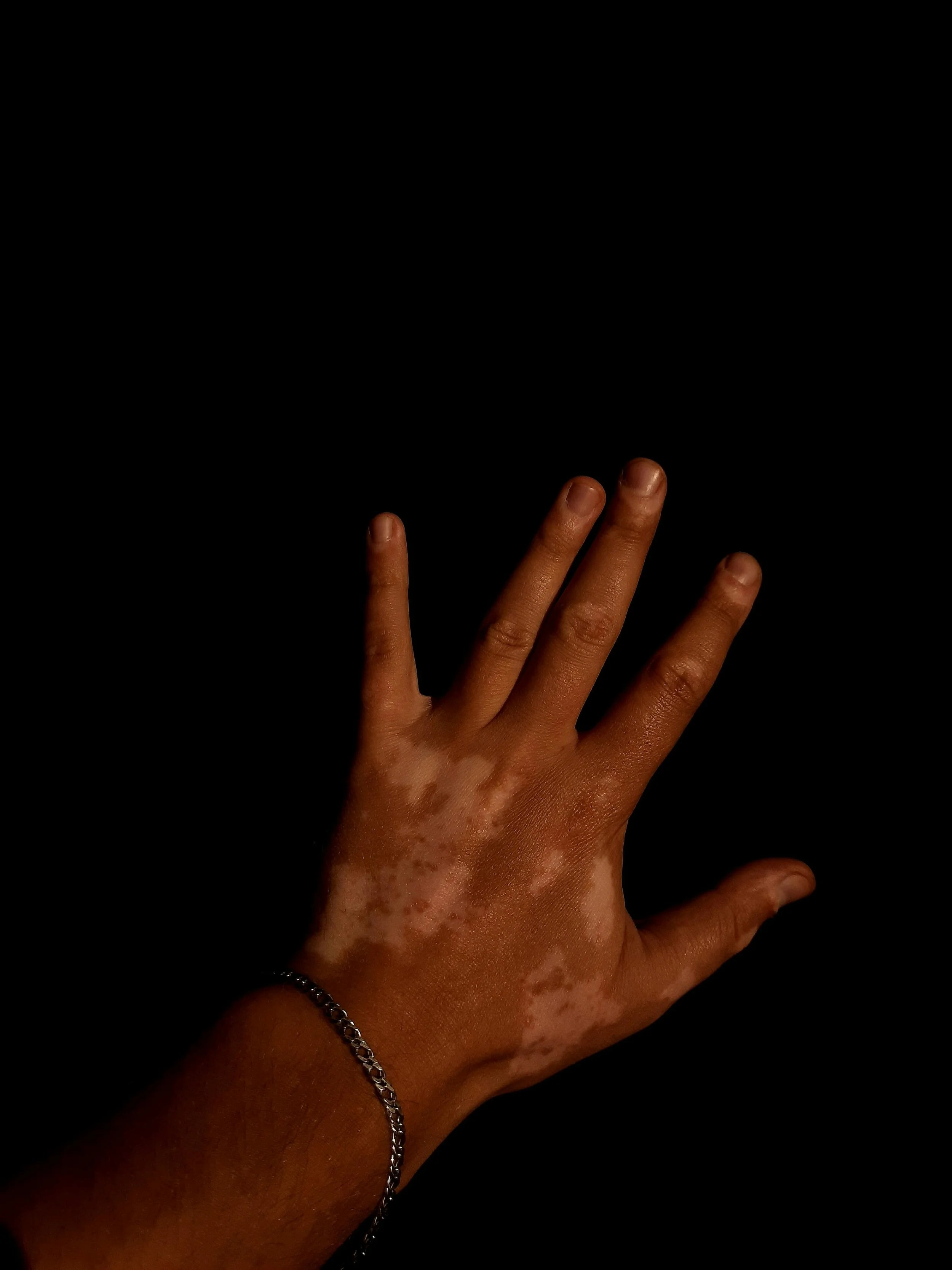 A hand with martian-like skin, showing reddish-brown spots, is extended against a dark background, wearing a silver chain bracelet.