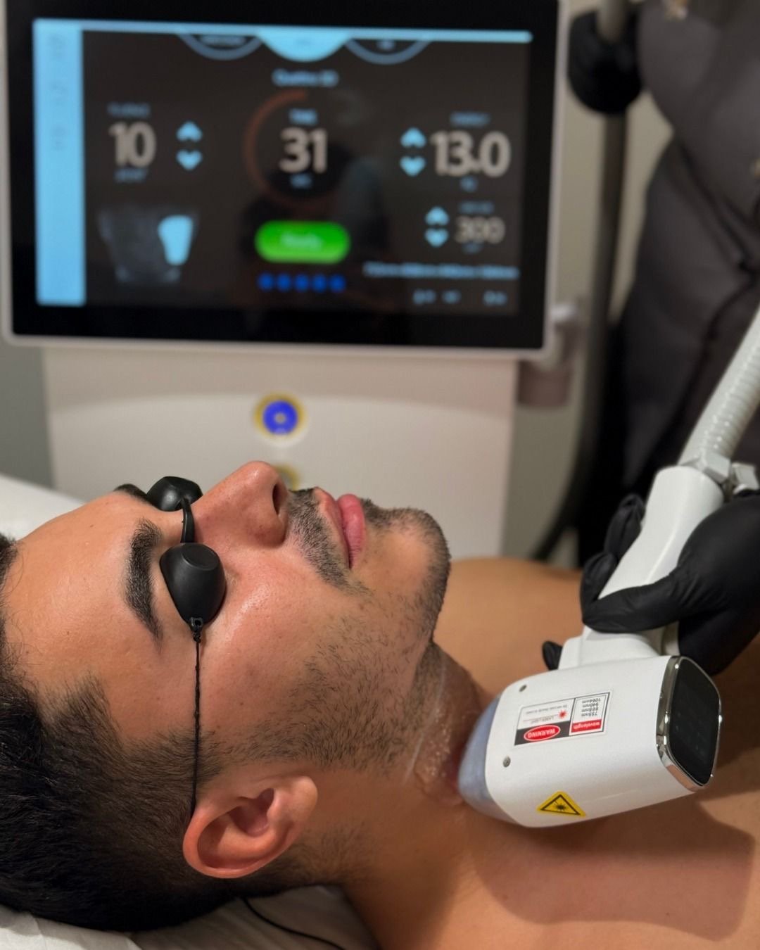 A man undergoing a laser skin treatment while lying down, wearing protective glasses, with a laser device held by a person in black gloves, in front of a medical monitor displaying treatment settings.
