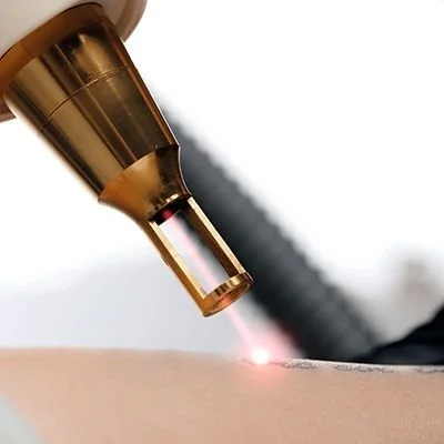 Pico laser tattoo removal device used during a treatment session in Salt Lake City