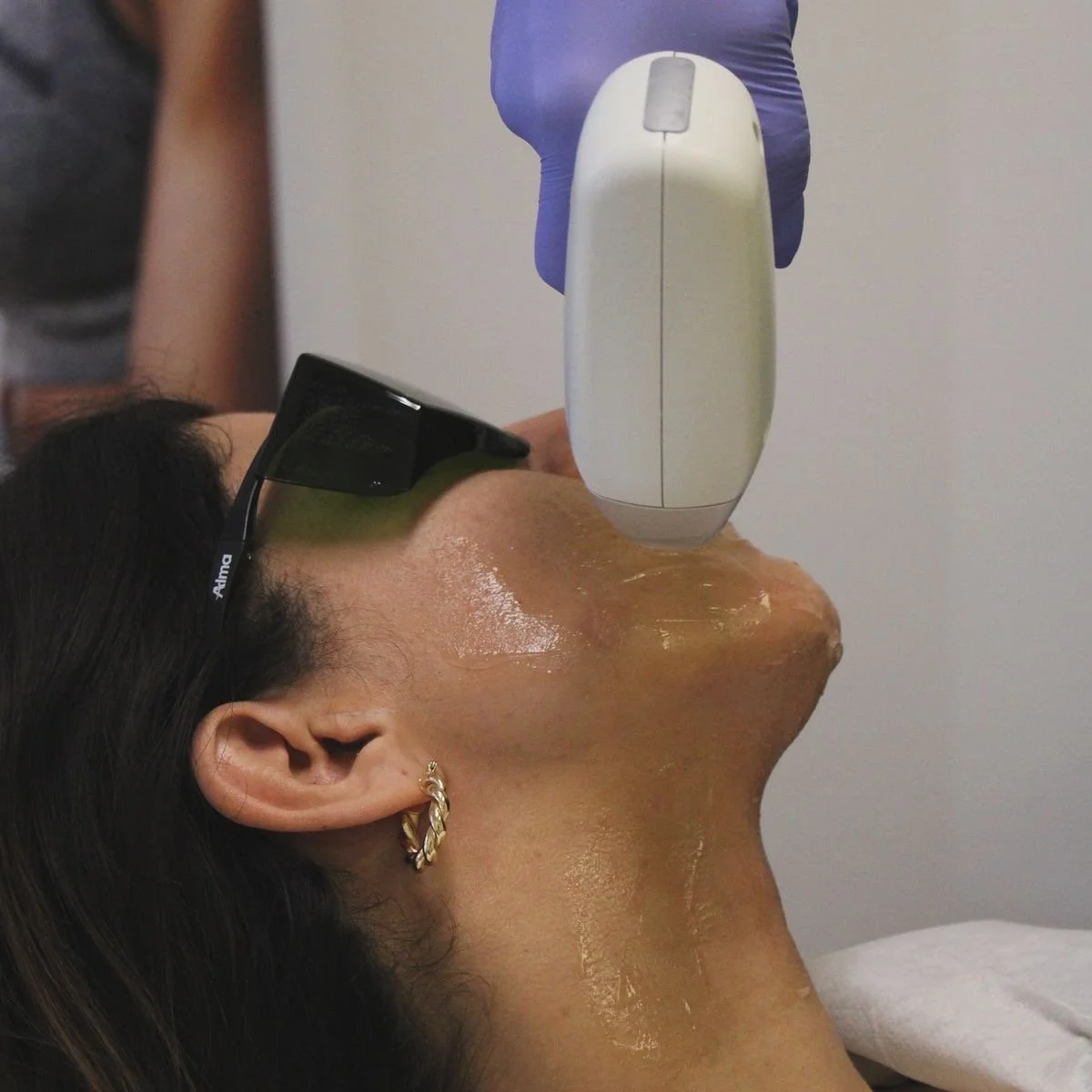 Person receiving a laser skin treatment on the chin, with a technician operating a laser device. The person is wearing glasses and gold hoop earrings.