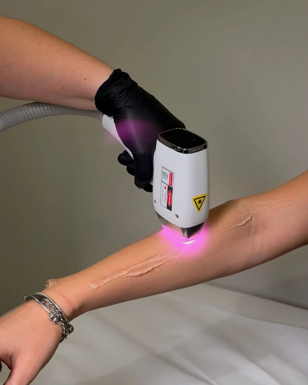 A person receiving laser hair removal on their forearm, with a professional using a laser device emitting purple light, while wearing black gloves.