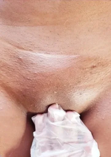 After photo of a brazilian wax.