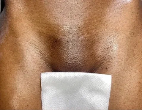 Close-up of a person's abdomen with a small white medical patch attached.