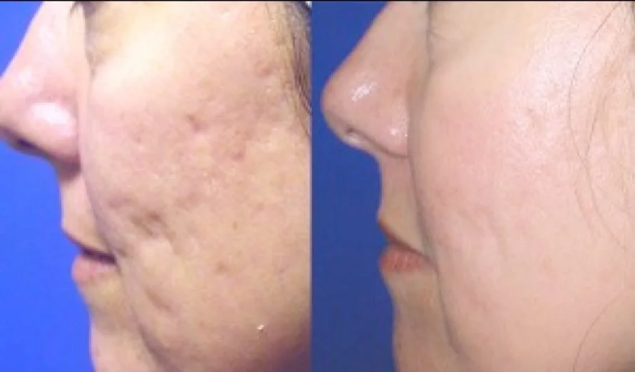 Acne scars? Uneven texture? Fine lines? Aging skin?

Healthy-looking skin starts with stimulating your skin&rsquo;s natural renewal process.

✨ ProCell&trade; Microchanneling is designed to improve the appearance of:
&bull; Acne scars
&bull; Fine lin