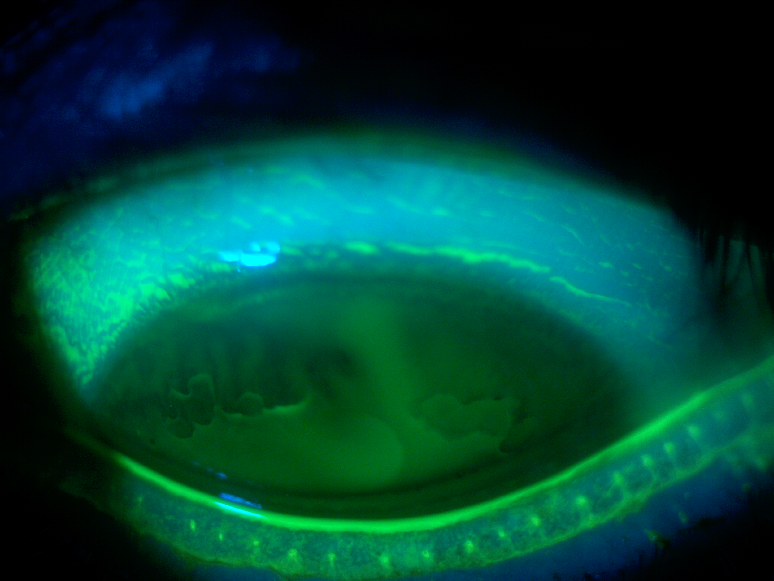 Severe Dry Eye Scleral lenses for Sjogren's Syndrome