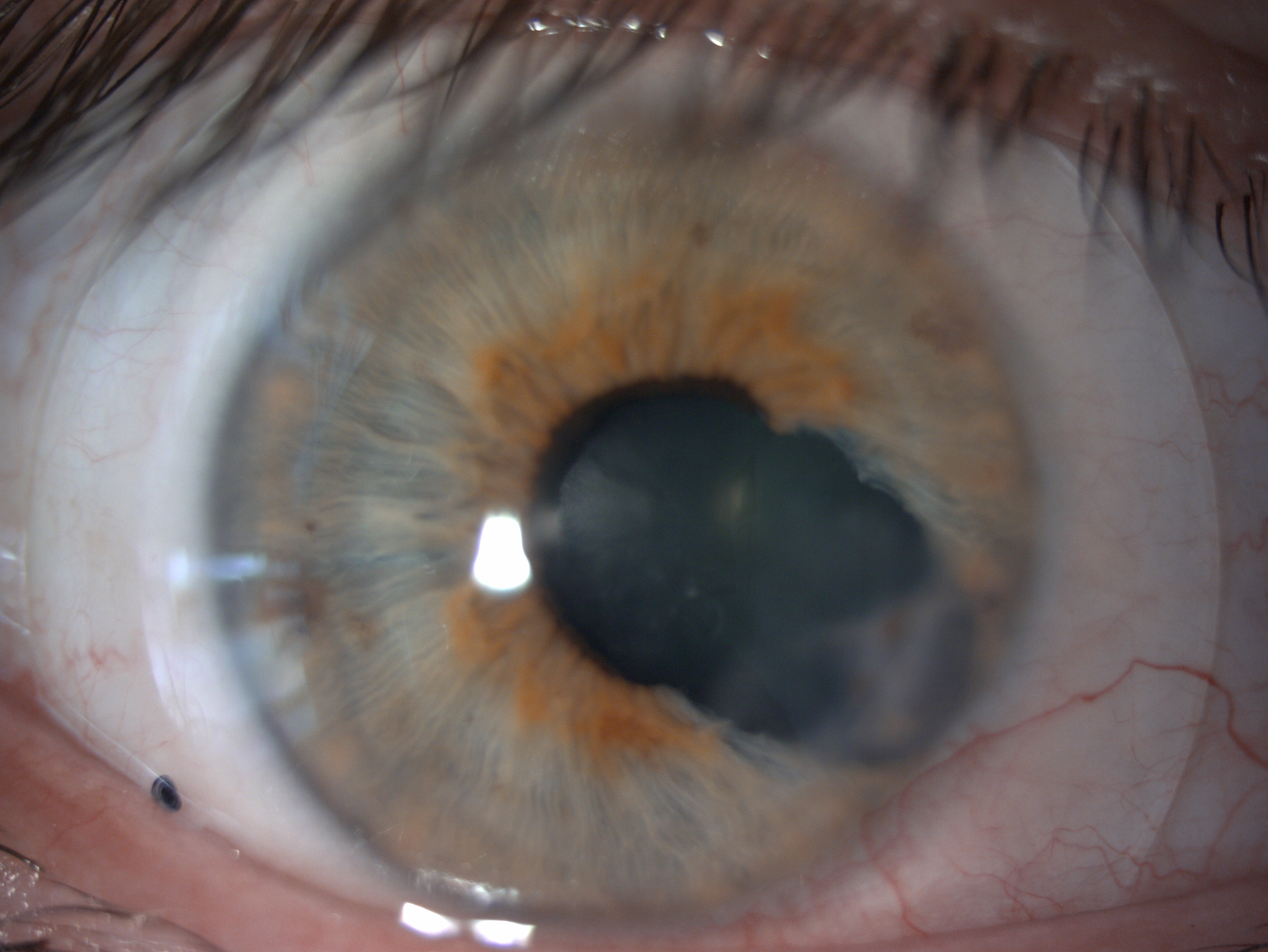 Scleral lenses with torn iris