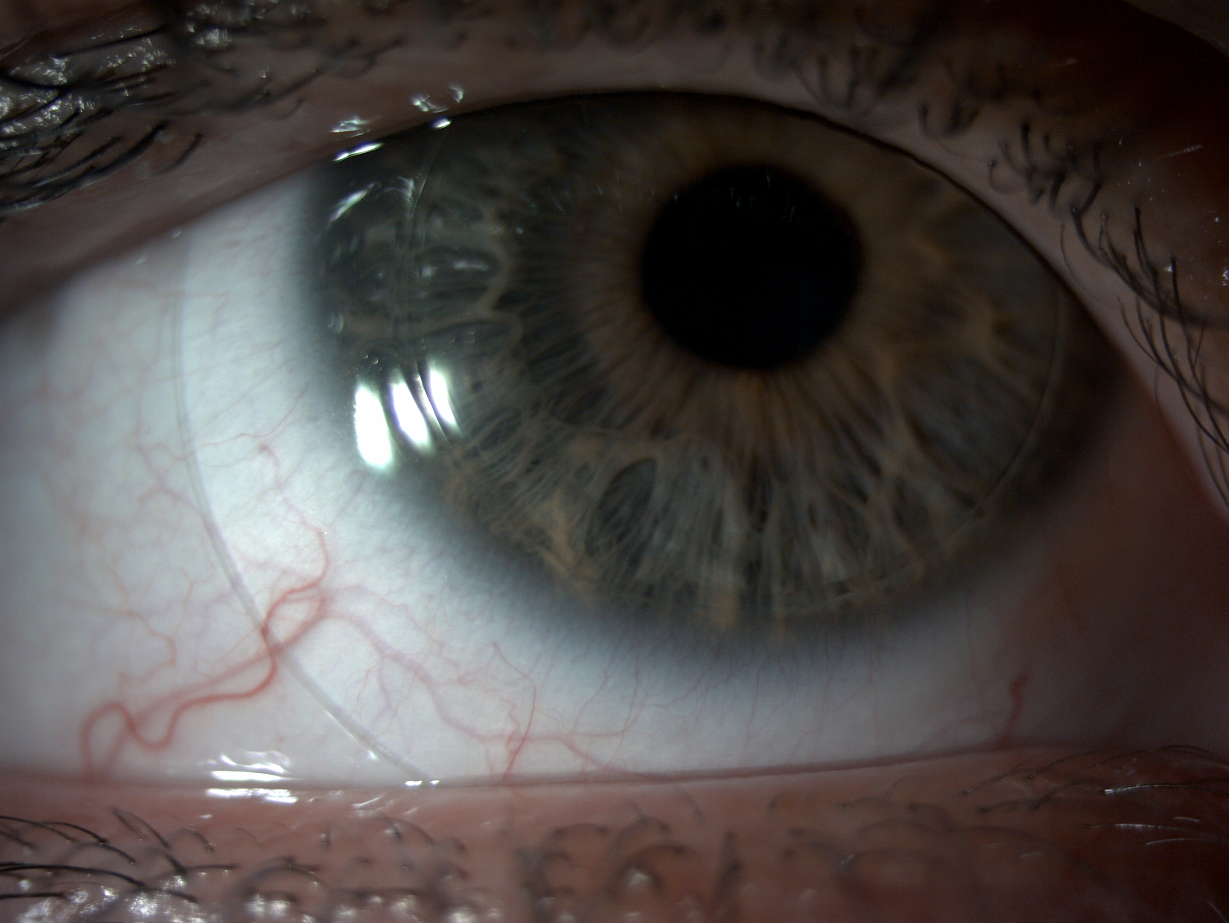 Synergeyes hybrid contact lens