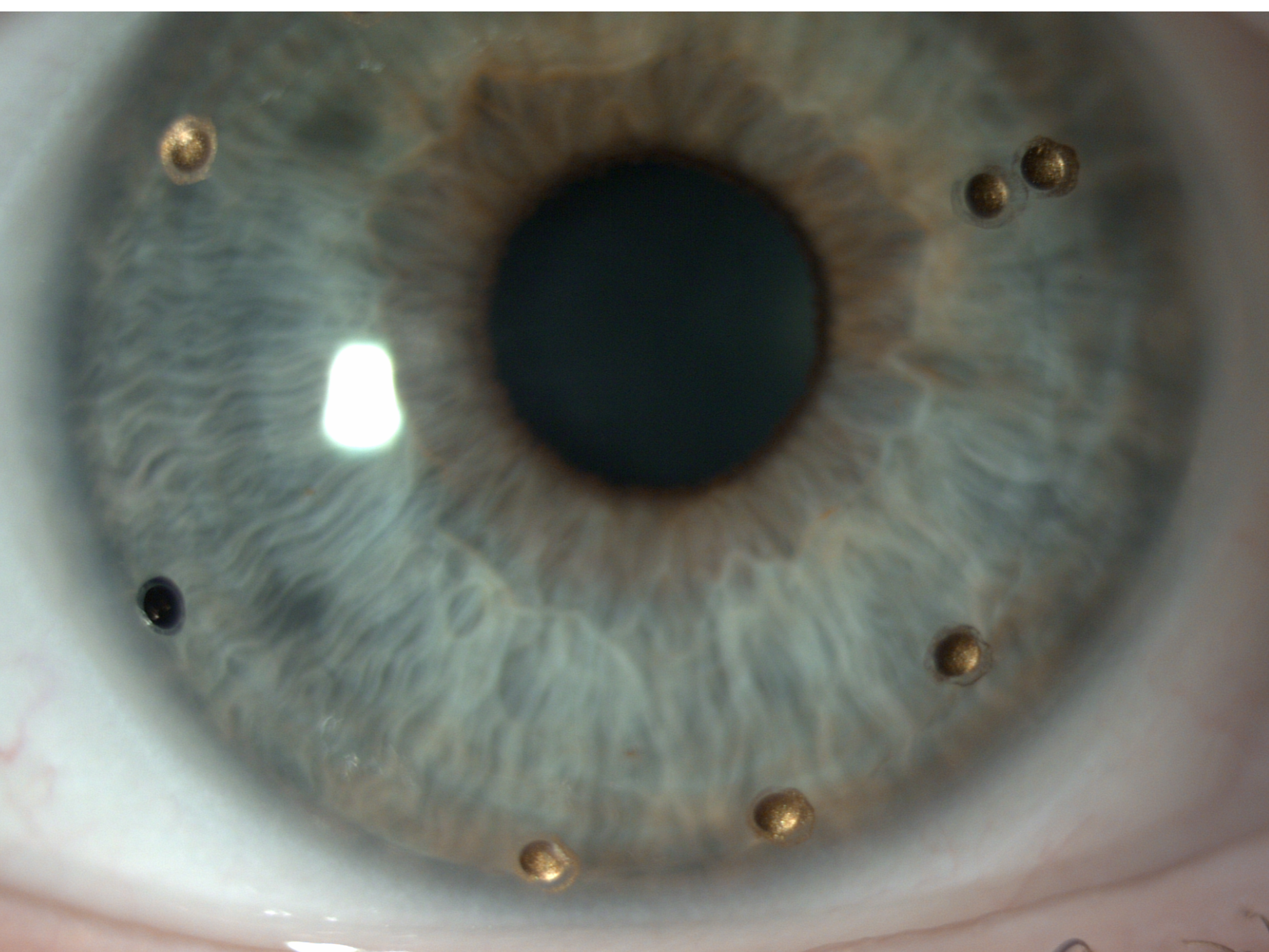 Close-up of a human eye with wavefront guided ovitz scleral lens.