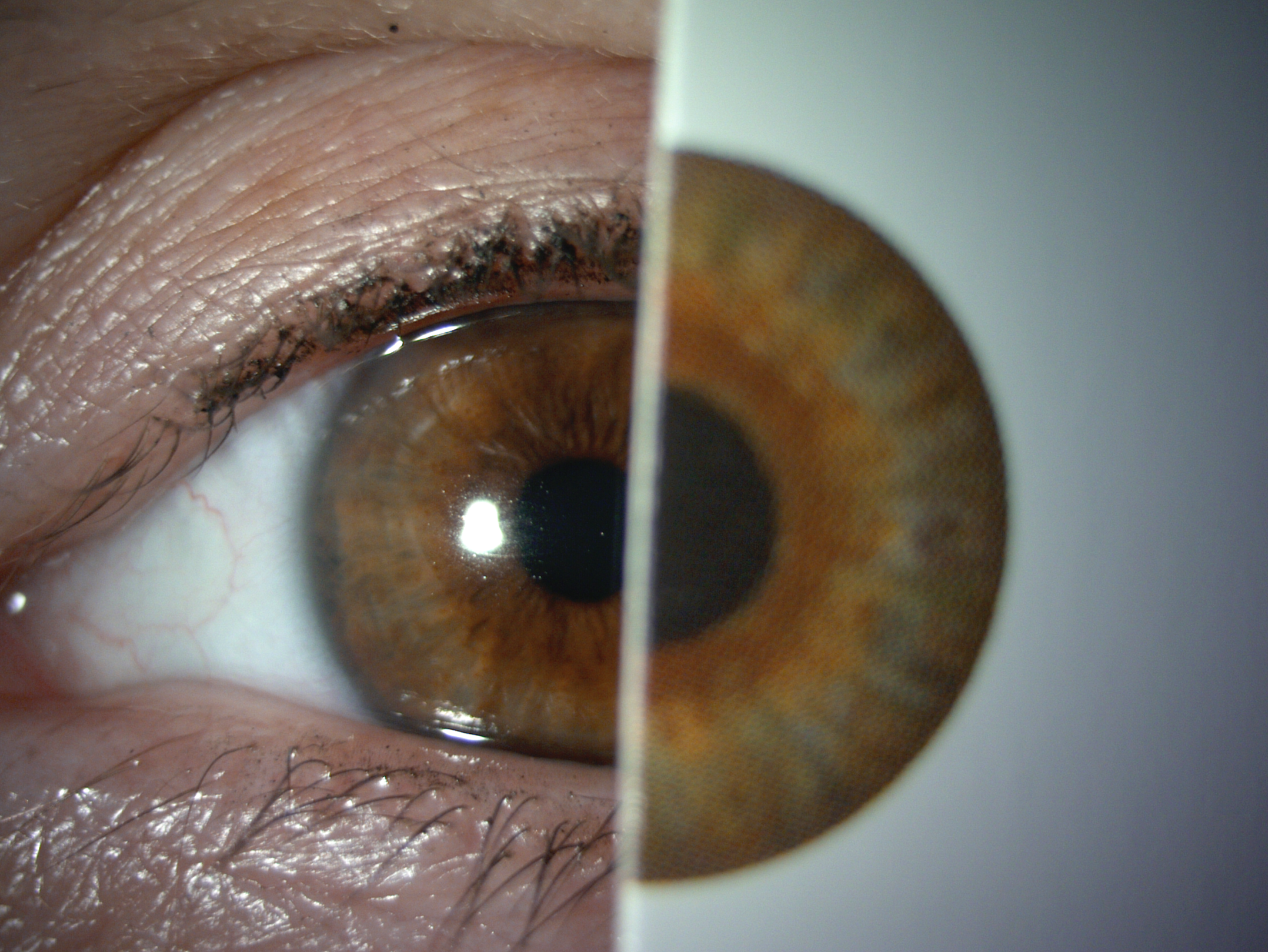 Prosthetic Contact Lens