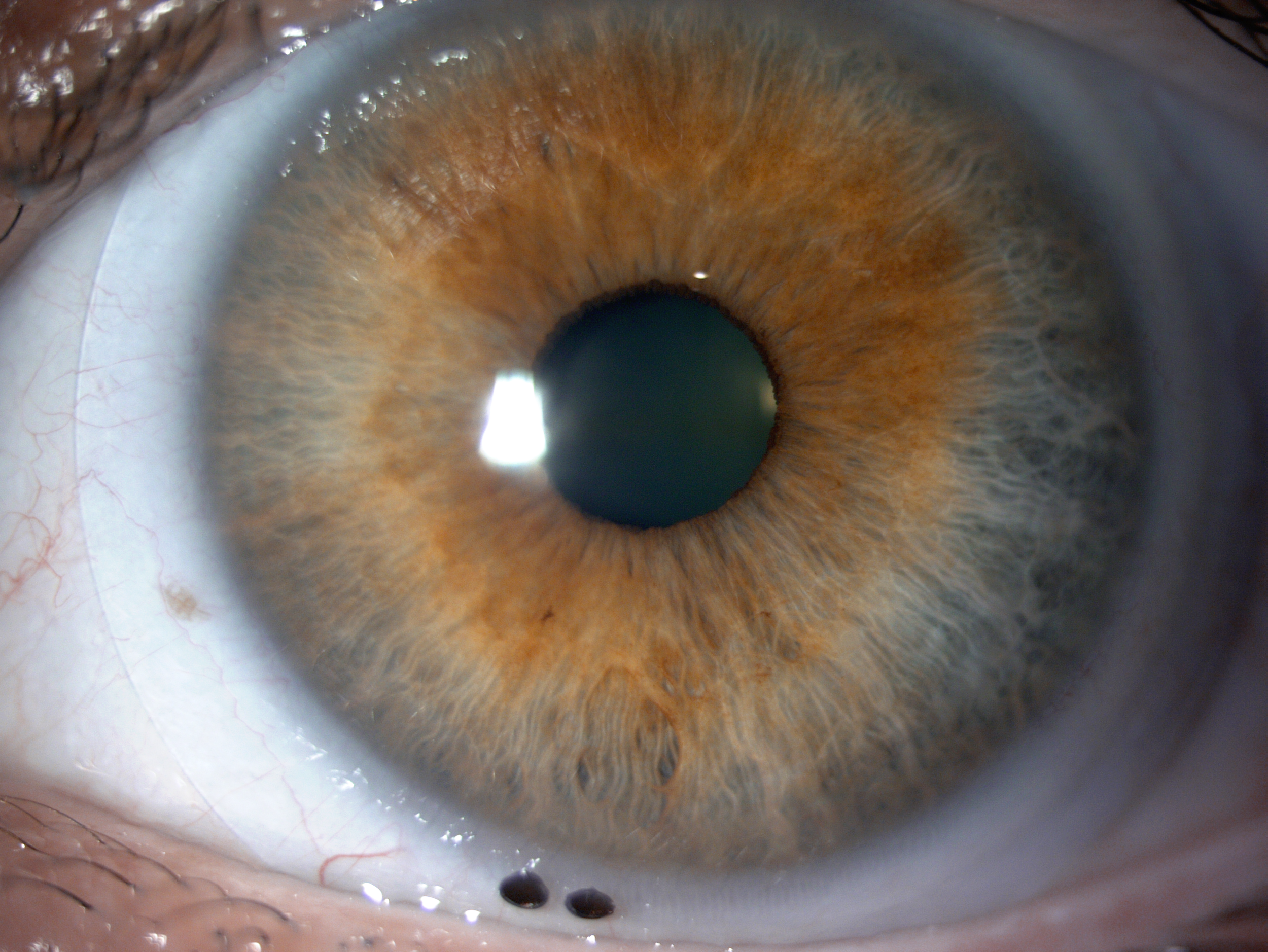 Standard scleral lens on an eye with keratoconus