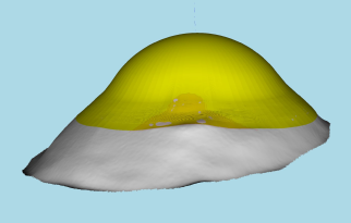 EyefitPro Eyeprintpro scleral lenses for pinguecula