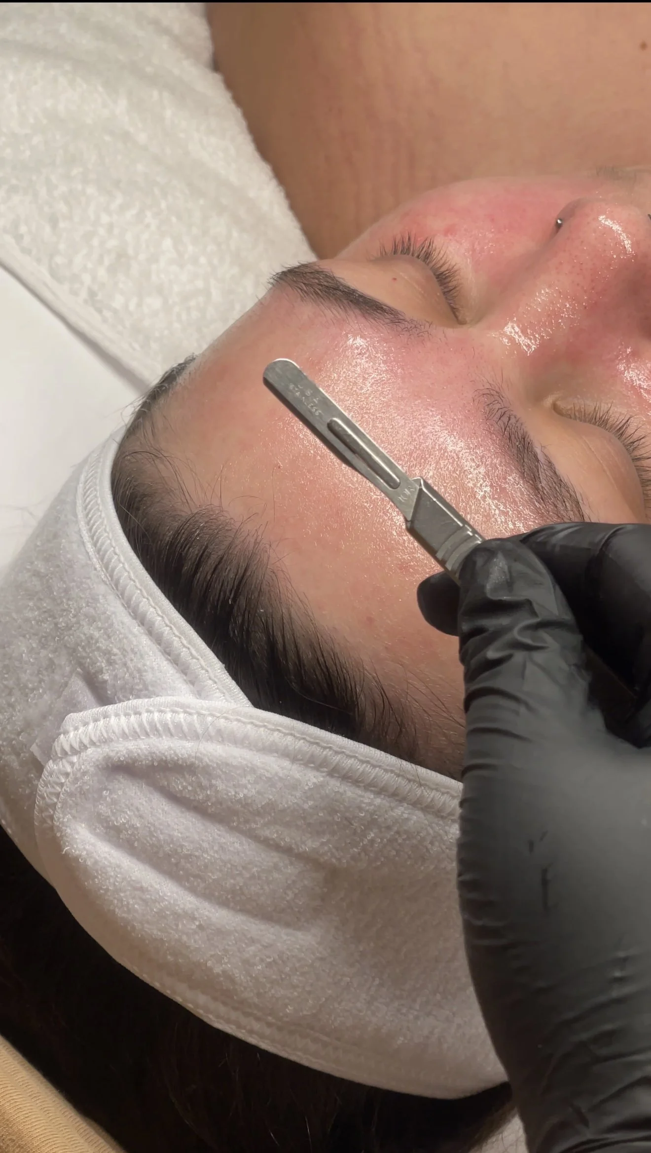 A client lying on a treatment table with a white headband, eyes closed and skin glistening, while a gloved esthetician performs dermaplaning on their forehead using a surgical blade.