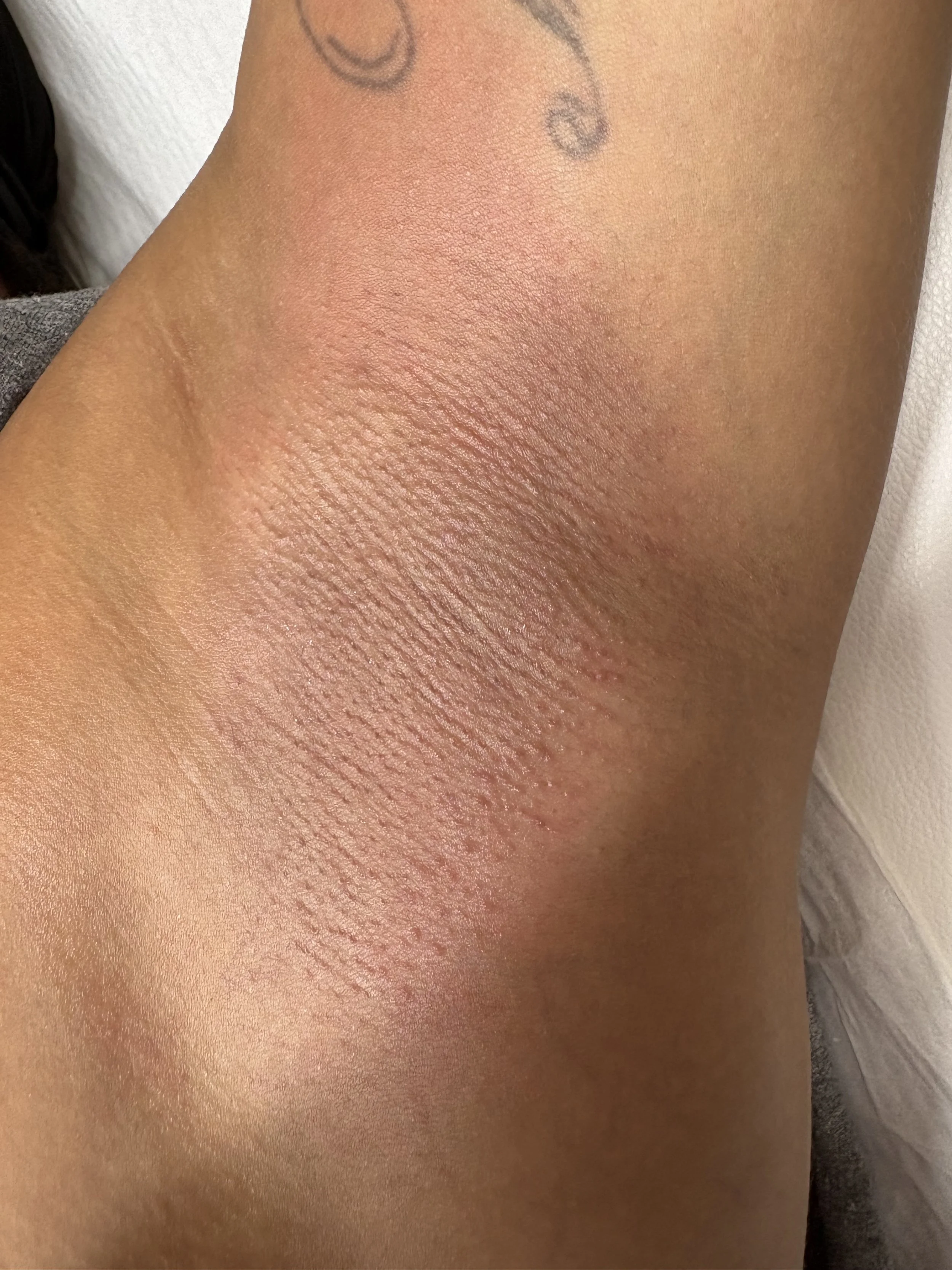 Close-up of a person's armpit with some redness and slight irritation.