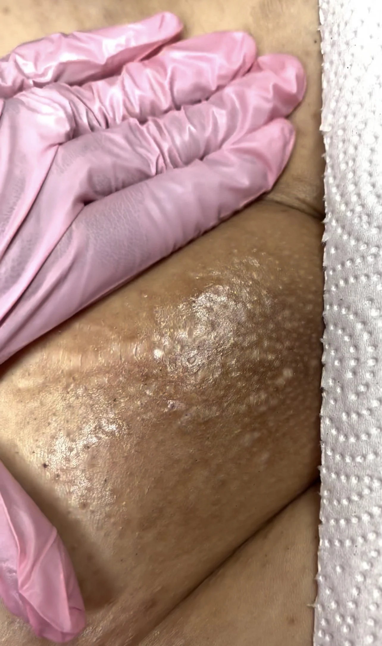Close-up of a person's skin with a dermatologist or healthcare worker in pink gloves examining a skin condition on their back.
