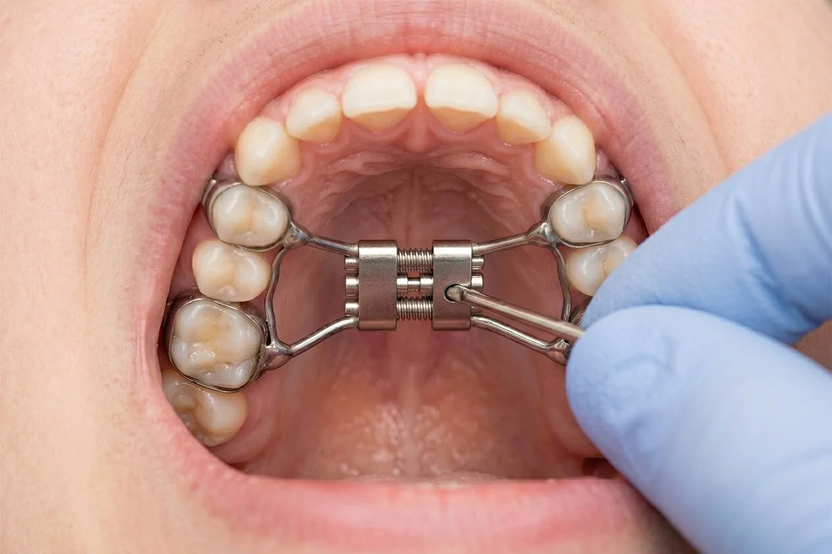 Life with a Palatal Expander: What to Expect at Drake Road Orthodontics