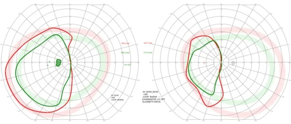 A pair of polar plot graphs showing visual field test results with green and red lines indicating different measurement data.