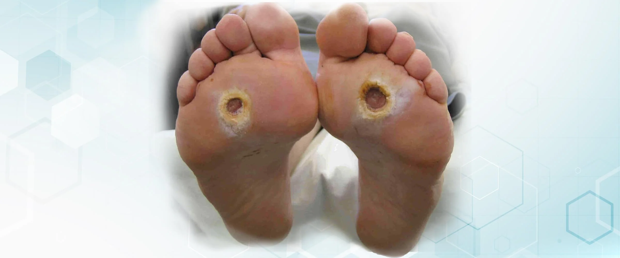 Close-up of the soles of two feet with infected wounds on the heels.