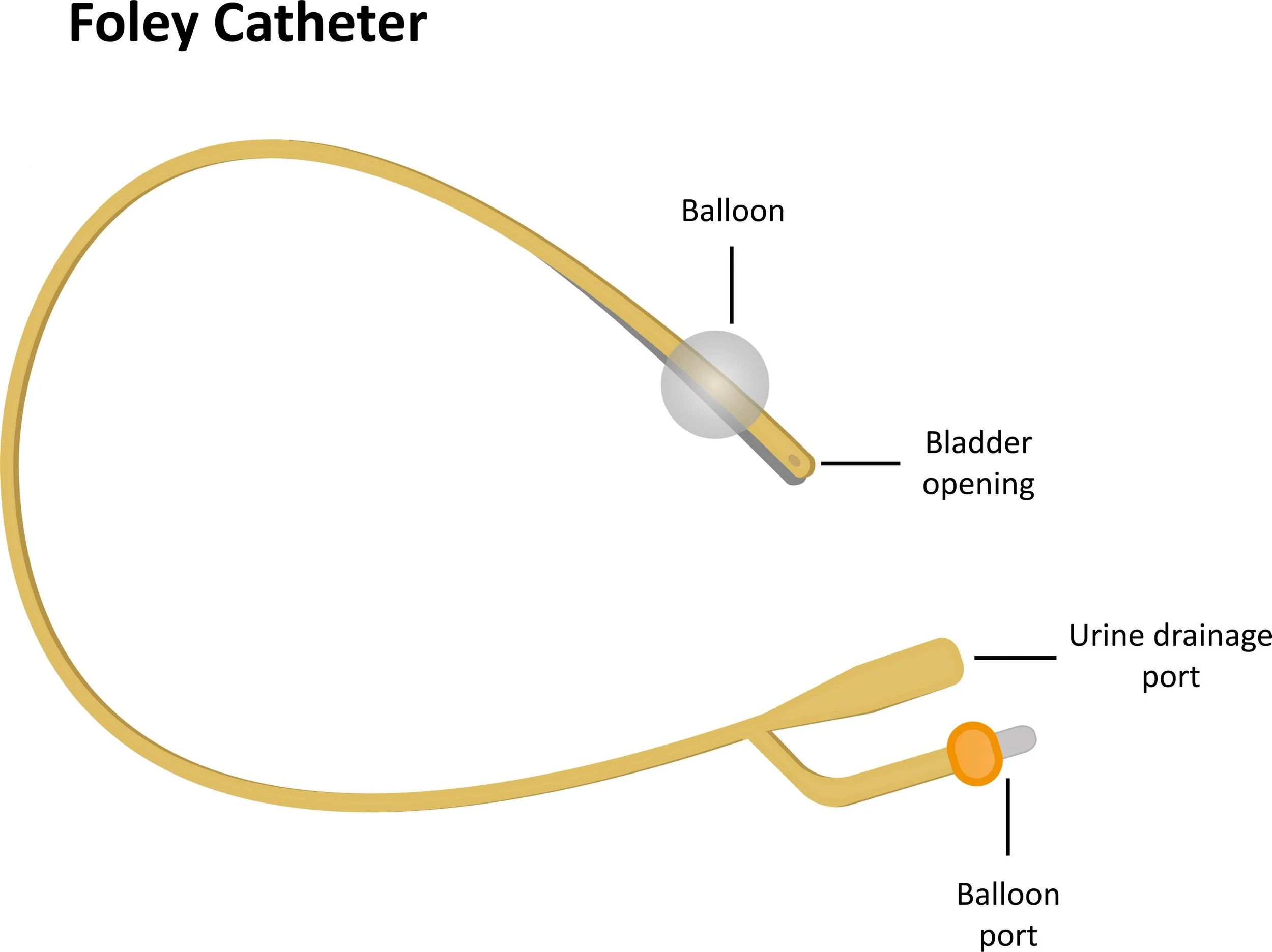 Diagram of Foley catheter with labeled parts: balloon, bladder opening, urine drainage port, and balloon port.